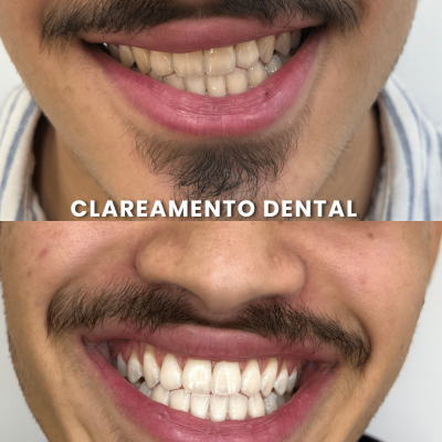 O clareamento dental é um procedimento popular que muitas pessoas buscam para melhorar a aparência de seus sorrisos. Antes de realizar o clareamento, os dentes podem apresentar manchas amareladas