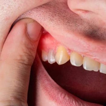 Red and swollen gums in a man. Gum disease gingivitis, gumboil and inflammation