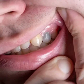 homem-mostrando-dente-com-cor-acinzentada-amp_hero-1