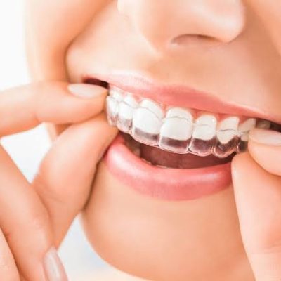 invisalign